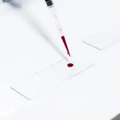Podwyższony poziom hematokrytu - najczęstsze przyczyny i objawy choroby